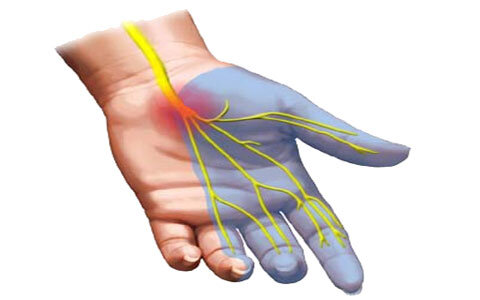 معرفی ۳ عامل اصلی که ریسک ابتلا به مچ درد را میافزایند