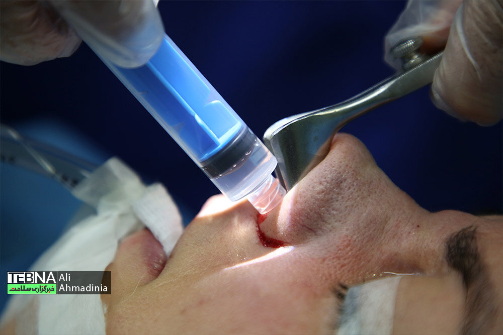 علت کج شدن بینی بعد از عمل جراحی بینی چیست؟