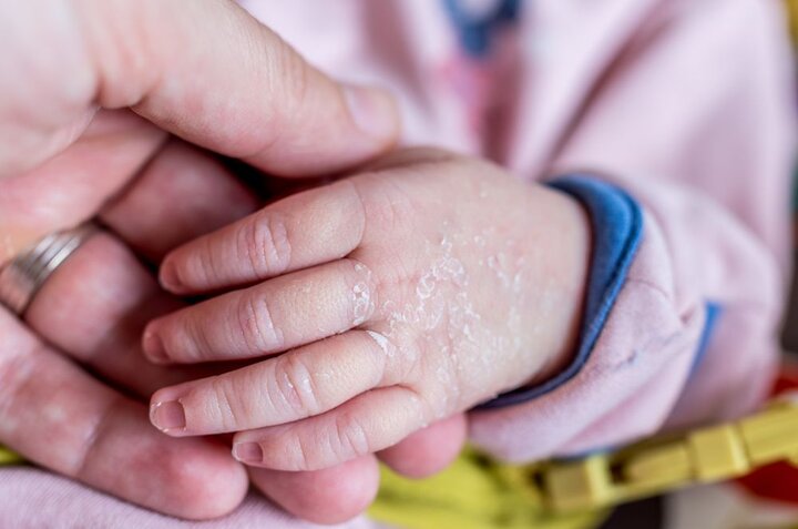 خشکی پوست در نوزادان، علت‌ها و درمان