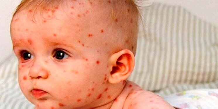 سرخک، بیماری حاد تنفسی و بسیار مسری