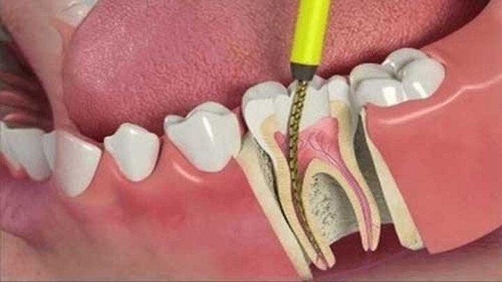 ساخت دستگاهی کاربردی در ترمیم ریشه دندان