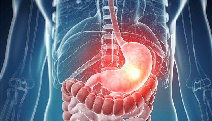 چگونه معده سرد را درمان کنیم؟
