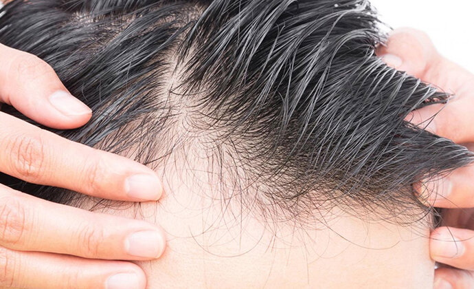 چند راهکار ساده برای جلوگیری از ریزش مو