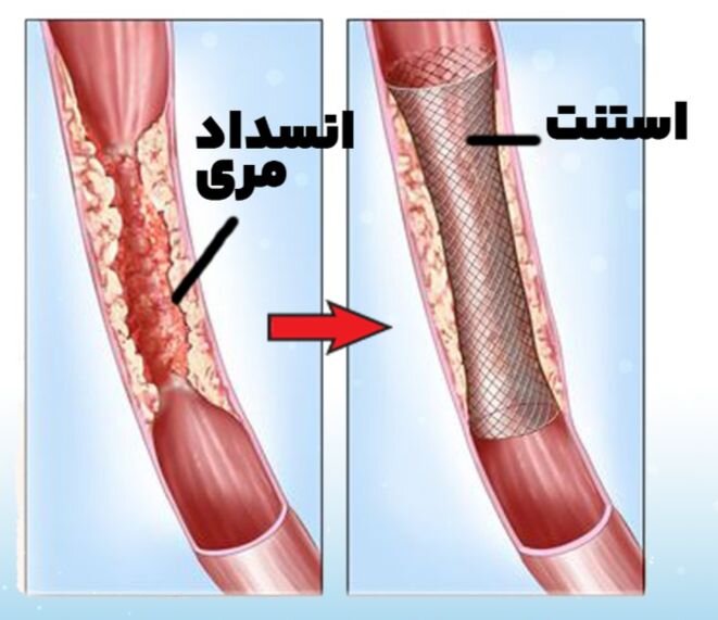 انجام موفقیت آمیز روش «استنت گذاری مری» برای اولین بار در سیرجان