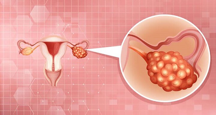 سرطان تخمدان، پنجمین سرطان شایع در زنان