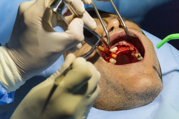 سمپوزیوم متریال ها و تکنیک های پیوند استخوان در جراحی های دهان