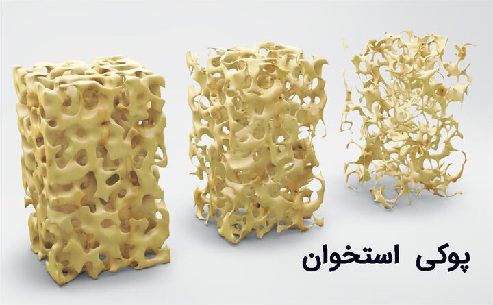 «کلسیم نانویی ایرانی» به درمان پوکی استخوان کمک می‌کند