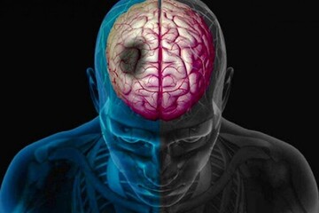 ۷ خطای رایج در مواجهه با سکته مغزی؛ چرا تماس فوری با ۱۱۵ حیاتی است؟