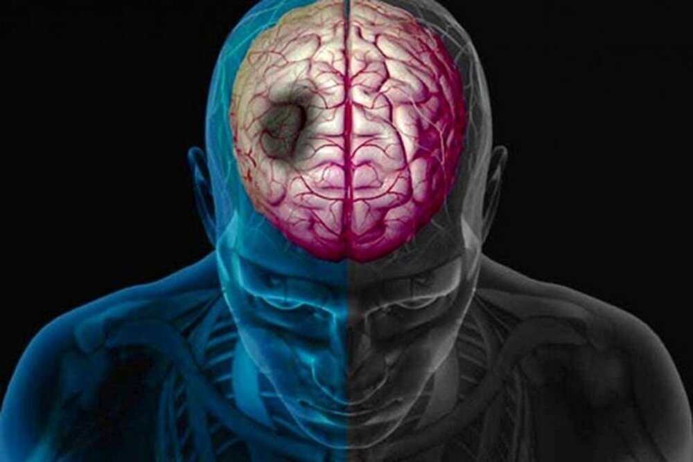 ۲۰۰ تهرانی روزانه سکته مغزی می کنند ۲۰۰ تهرانی روزانه سکته مغزی می کنند