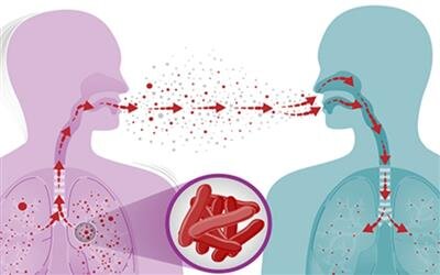 قطرات تنفسی آلوده تنها راه انتقال بیماری سل