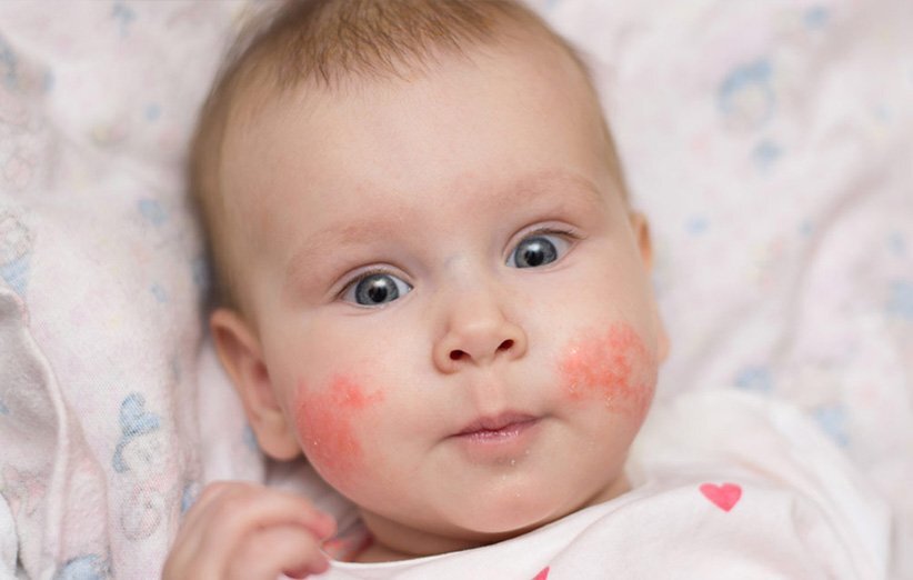 کودکان مبتلا به اگزما بیشتر در خطر سایر بیماری های پوستی هستند