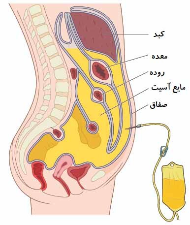 آب آوردن شکم باعث مرگ می شود؟
