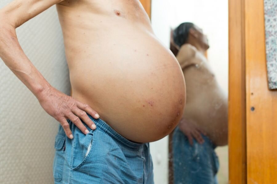 آیا آب آوردن شکم یا آسیت خطرناک است؟