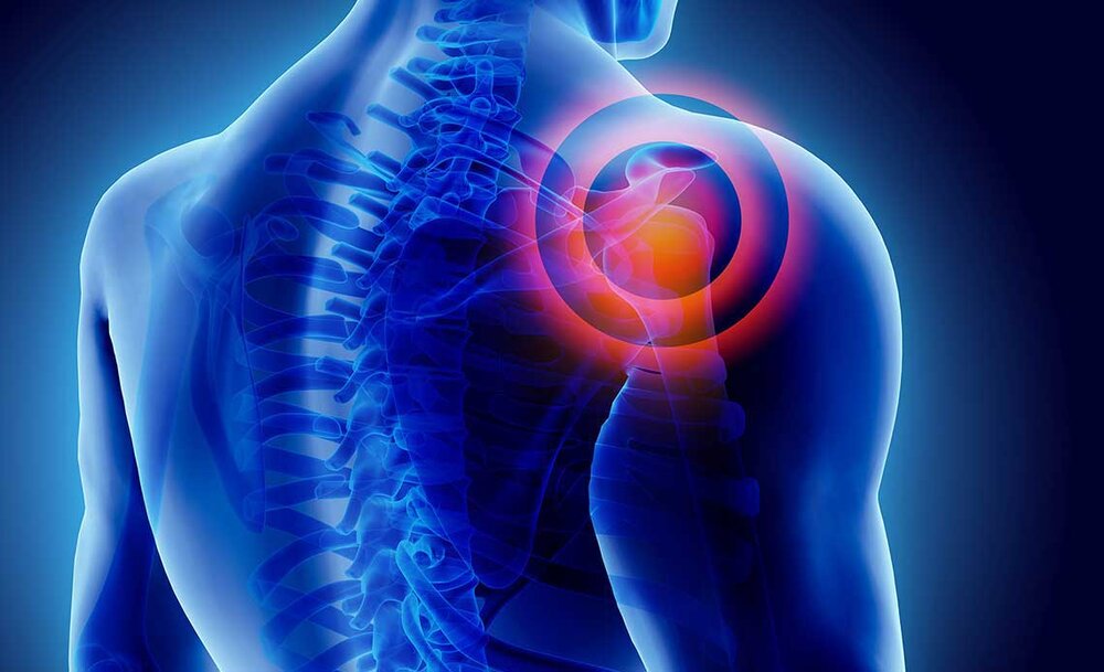 شانه منجمد؛ محدودیت حرکتی با سفت شدن کیسه مفصلی