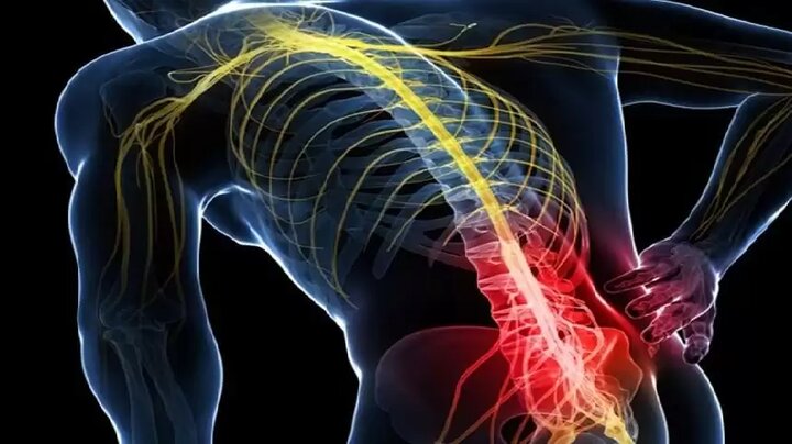 فیزیوتراپی سیاتیک، درمان  چه زمانی واقعاً ضروری است؟