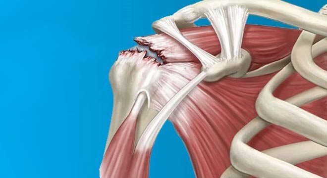 پارگی روتاتور کاف را از علت تا درمان آن بشناسید