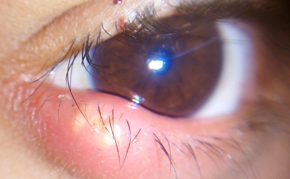 ۸ عفونت چشم؛ علل ابتلا، علائم و اقدامات درمانی که حتما باید بدانید!