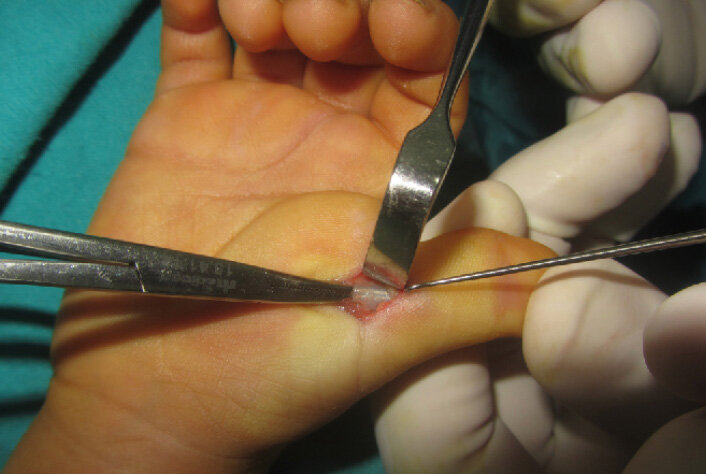 انگشت ماشه ای عارضهای شایع بین زنان و هنرمندان صنایع دستی