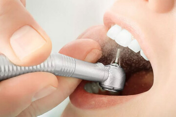 بروساژ دندان چیست/فواید انجام بروساژ دندان