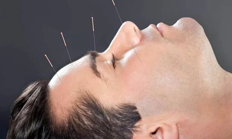 طب سوزنی کدام بیماریها را درمان میکند طب سوزنی کدام بیماریها را درمان میکند
