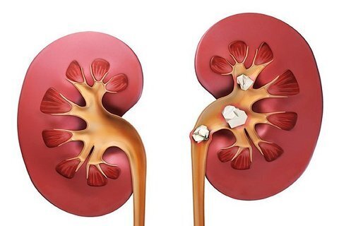 چگونه از سنگ کلیه پیشگیری کنیم؟ چگونه از سنگ کلیه پیشگیری کنیم؟