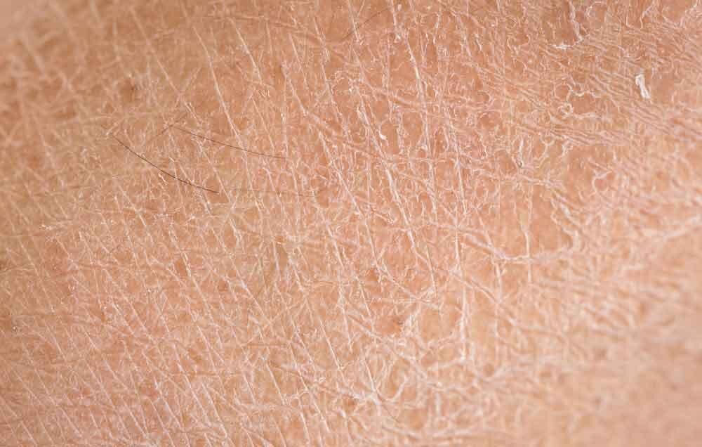 راه های درمان خشکی پوست