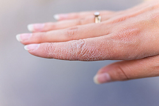 درمان خشکی پوست دست با روش های خانگی