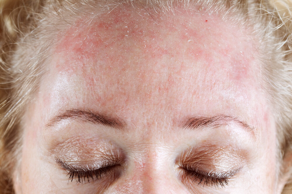 بهترین روش های درمان خشکی پوست صورت