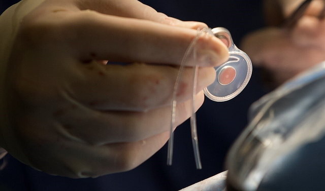 نیاز کشور به ۲۰۰۰ پروتز شنوایی طی امسال/ یارانه ۲۵ میلیونی برای پروتز گوش دوم