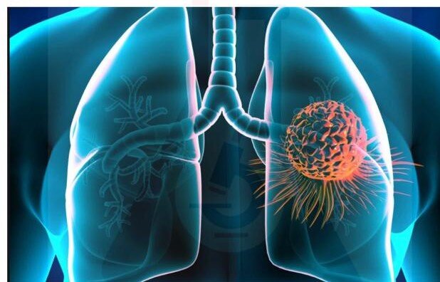 تشخیص زودهنگام سرطان کشنده ریه توسط محققان ایرانی