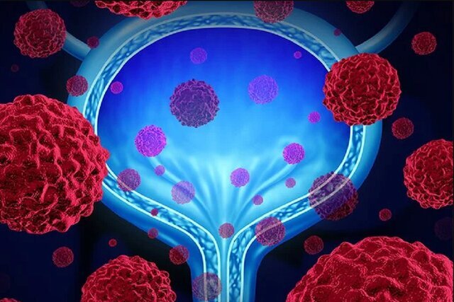 راهکار کاهش پیشروی سرطان مثانه راهکار کاهش پیشروی سرطان مثانه