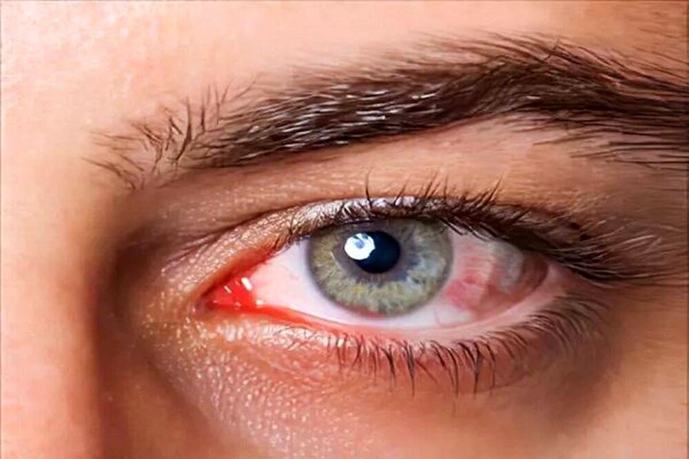 نوآوری در ترمیم قرنیه