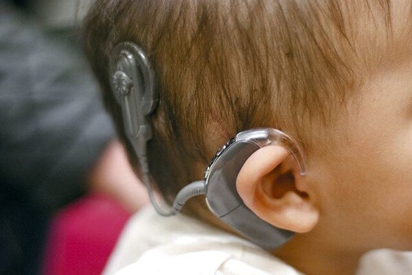 انقلاب در کاشت حلزون شنوایی؛ هزینه ۲۰۰ میلیونی که رایگان شد