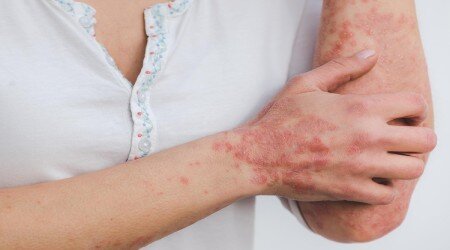 آشنایی با راه های پیشگیری از ابتلا به قارچ پوستی