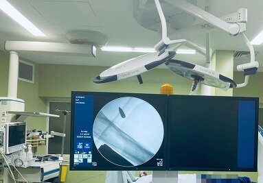 خارج کردن گلوله، پس از ۴۰ سال از بدن جانباز شیرازی