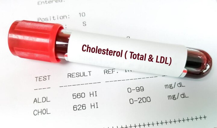 کلسترول خوب به کاهش خطر این بیماری کمک می کند