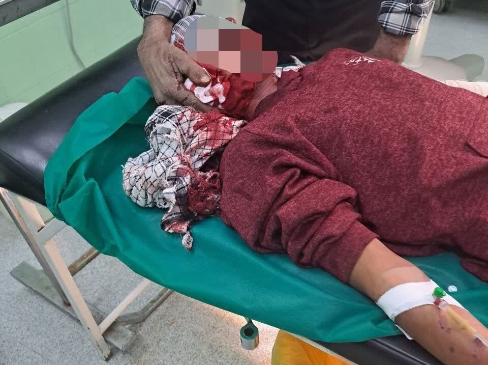 خوشبختانه در این حوادث موردی از فوت گزارش نشده است، اما دو مورد قطع عضو در حد بند اول انگشت دست ثبت شده است خوشبختانه در این حوادث موردی از فوت گزارش نشده است، اما دو مورد قطع عضو در حد بند اول انگشت دست ثبت شده است