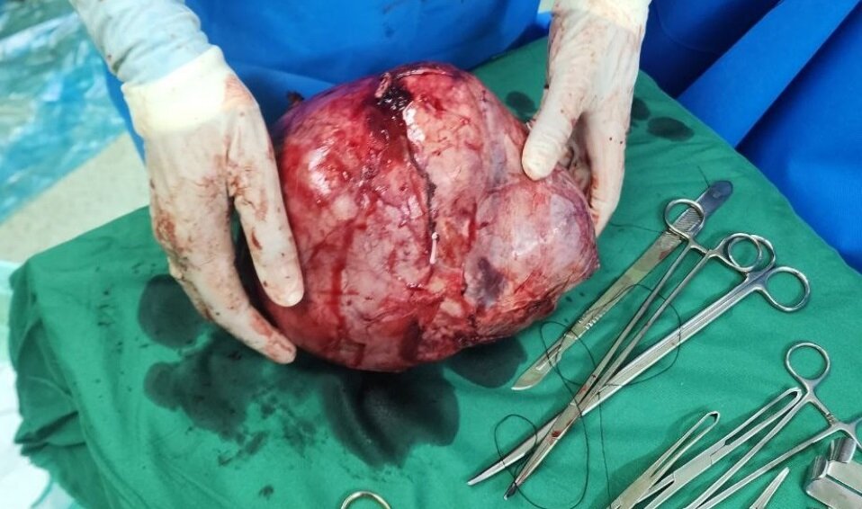 خارج ساختن توده ۵ و نیم کیلویی از شکم یک بیمار در کرمان خارج ساختن توده ۵ و نیم کیلویی از شکم یک بیمار در کرمان