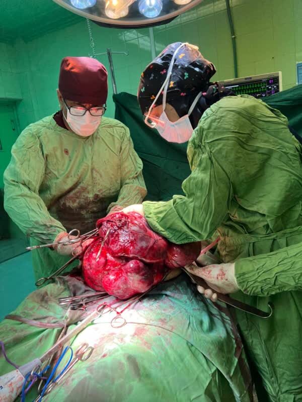 خارج‌کردن ‌تومور «۱۱ کیلویی» از شکم بیمار در بیمارستان گراش فارس