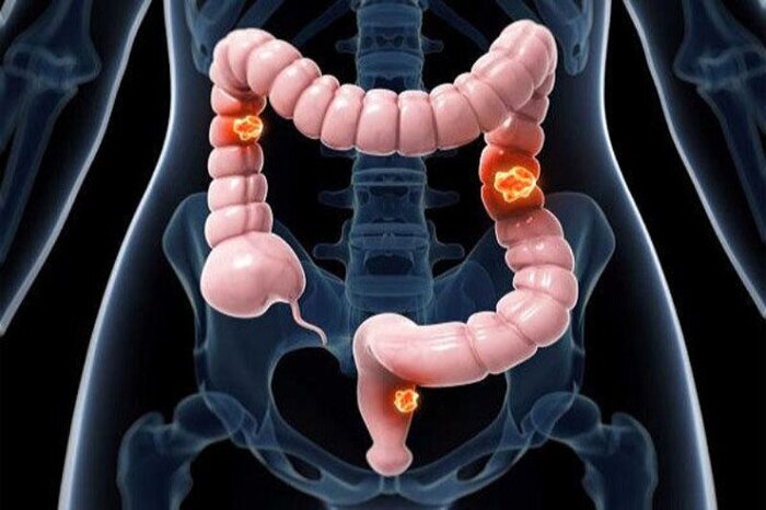 نقش کم خوابی و استرس در پیشرفت سرطان نقش کم خوابی و استرس در پیشرفت سرطان