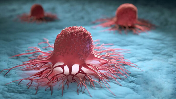 بی‌توجهی به سلیاک و احتمال ابتلا به سرطان روده