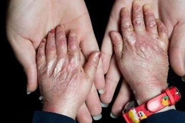 افزودن ۲۵ بیماری جدید به فهرست بیماریهای نادر