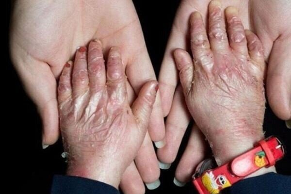 افزودن ۲۵ بیماری جدید به فهرست بیماریهای نادر افزودن ۲۵ بیماری جدید به فهرست بیماریهای نادر