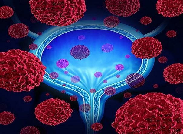 مهمترین عوامل ایجاد سرطان مثانه مهمترین عوامل ایجاد سرطان مثانه