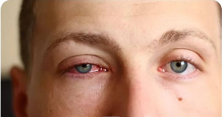 عفونت انگلی «آکانتامبا»؛ خطر تشخیص اشتباه و از دست رفتن دائم بینایی