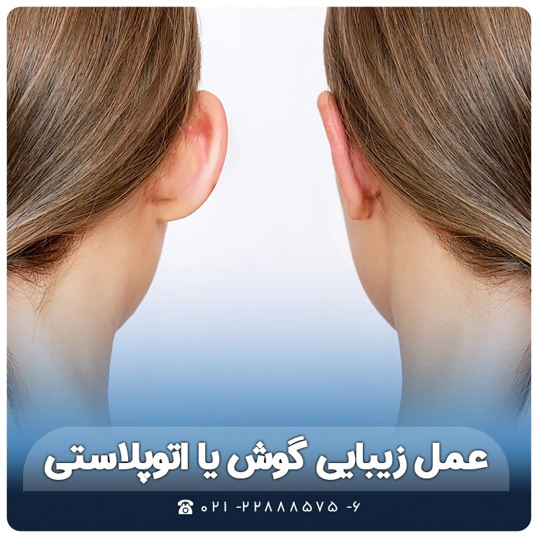عمل زیبایی گوش یا اتوپلاستی عمل زیبایی گوش یا اتوپلاستی