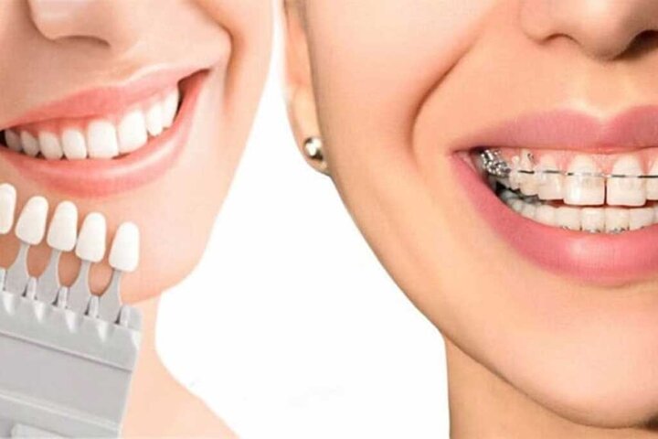 آنچه باید پیش از بلیچینگ دندان بدانید/ زیبایی لبخند بدون آسیب به دندان