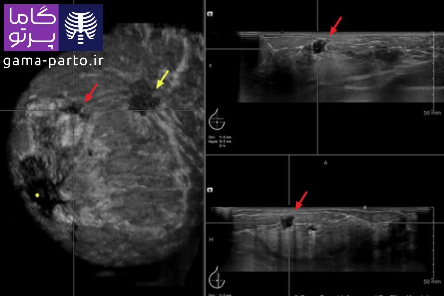 سونوگرافی سرطان سینه - گاما پرتو
