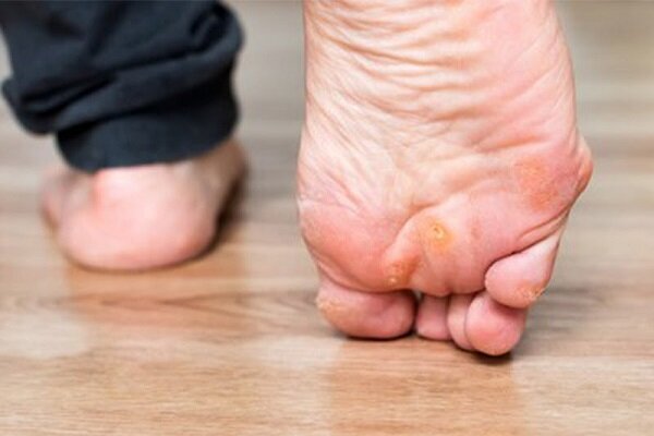 میخچه پا چیست و چگونه درمان میشود؟ میخچه پا چیست و چگونه درمان میشود؟