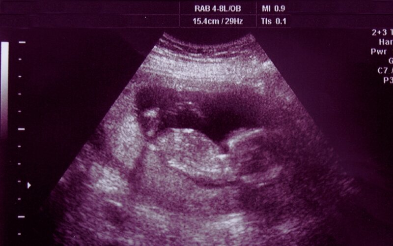 آیا غربالگری‌های بارداری اجباری و مهم است؟